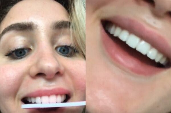 Mulher serrando os dentes (à esquerda) e a foto dos dentes dela retos (à dir)