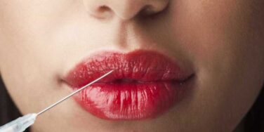 tudo sobre o preenchimento labial