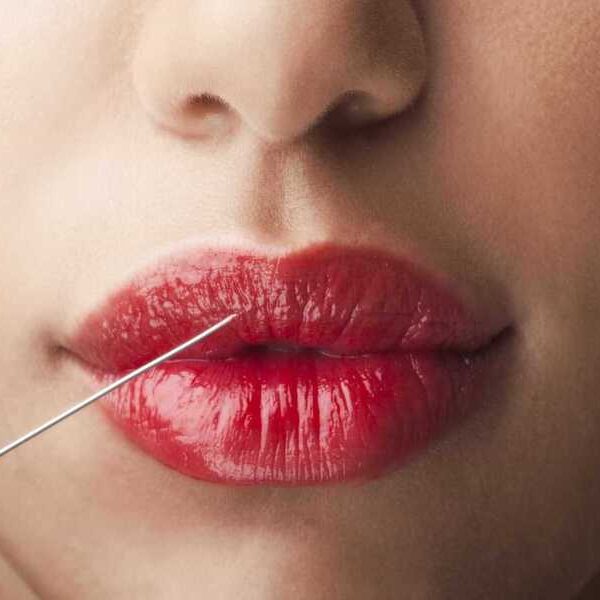 tudo sobre o preenchimento labial