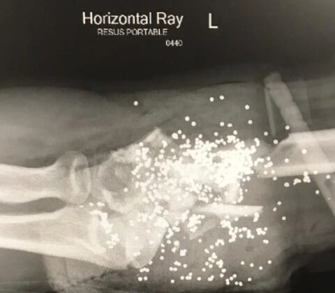 Radiografias assustadoras de acidentes reais que só os fortes conseguirão ver